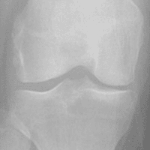 Grade 1 이미지